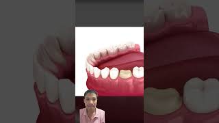 Gentle Dental Care ASMR Cavity Removal and Crown Replacement asmr dentition shorts [upl. by Preiser]