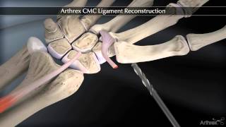 Arthrex CMC Ligament Reconstruction [upl. by Naujat]