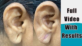 Ear Lobe  Ear Hole Ear Pasting Glue  Ear Pasting Lotion  Ear Lobe Repairing With Out Stiches [upl. by Jorey]