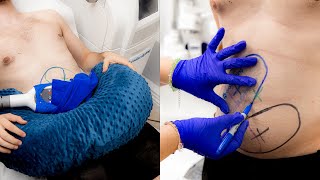 Coolsculpting for men  Body Sculpting in London [upl. by Rufina]