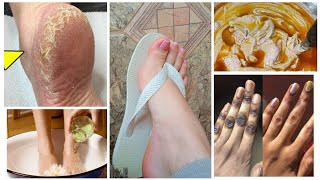 sida locadeyo lugaha cirbo jilicsan😱5 mins Remove Cracked Heels and Get Beautiful Feet [upl. by Airolg264]