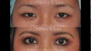 Symmetry ptosis in Asian eyelid surgery by Dr Charles S Lee [upl. by Terry]