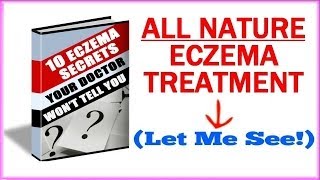 Eczema Treatment  How To Get Rid Of Eczema Naturally [upl. by Llevart838]