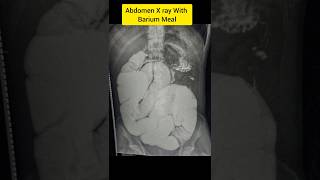 Abdomen X ray with Barium Meal [upl. by Arianna]