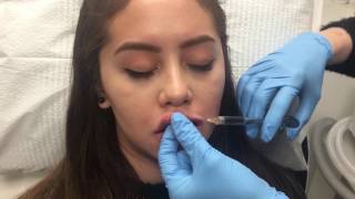 Live Lip Augmentation  Juvéderm Injection [upl. by Hak198]