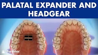 Orthodontic devices  Palatal expander and headgear © [upl. by Ginny]