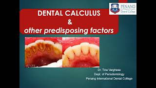 CALCULUS amp OTHER PREDISPOSING FACTORS [upl. by Shama]