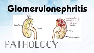 Glomerulonephritis Pathology [upl. by Yoc]