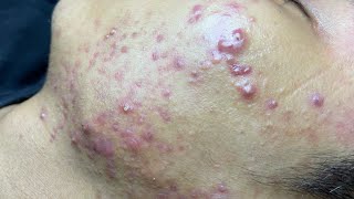 ACNE TREATMENT VU QUYNH MI  Blackheads Of Tweens 2024 EX [upl. by Joye412]