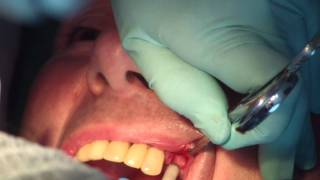 Préparation et pose dun implant dentaire partie 2 de 3 JMM DENTAL IMPLANT [upl. by Adnilahs]