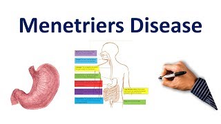 Menetriers Disease Made Easy USMLE Step 1 NCLEX COMLEX [upl. by Caylor]