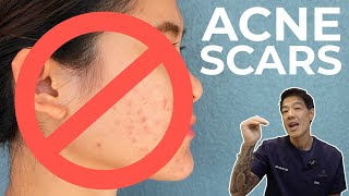 How to get rid of Acne Scars  Dr Davin Lim [upl. by Lovich778]