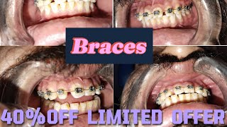 Ortho Braces Price in PakistanTooth Braces Cost in IslamabadBraces Before ampAfterBraces Process [upl. by Jung342]