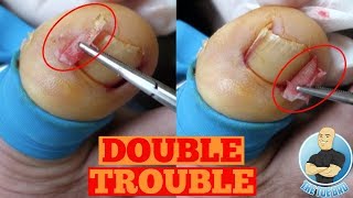 DOUBLE INGROWN TOENAIL REMOVAL FOREVERToe Nail Surgery by The Toe Bro [upl. by Tippets]