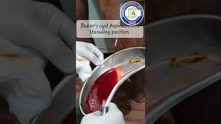 Bakers cyst Aspiration in Standing position  Adamya Hospital videos [upl. by Liana]