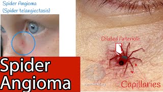 Spider Angioma  Capillaries on the face Spider spider telangiectasia Causes and Treatment [upl. by Hailee740]