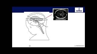 Aula Teórica Teus Ginecologia e Obstetrícia  Neurossonografia Fetal [upl. by Kreis81]