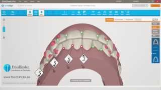 Invisalign ClinCheck Pro Tutorial contatos oclusales  Ortodoncia Friedländer Barcelona [upl. by Freya]