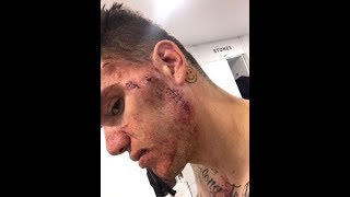 Ederson shows off the scars after being kicked by Mane [upl. by Goodkin]