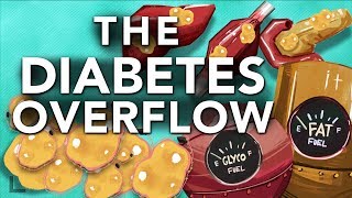 Obesity amp Diabetes Explained The Overflow Phenomenon [upl. by Atonsah]