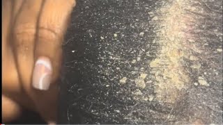 Dandruff scratching black removal scalp asmr dandruff scratching black removal scalp asmr [upl. by Poppy]