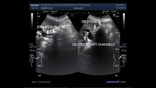 Ultrasound Video showing cholelithiasis associated with Choledocholelithiasis [upl. by Leasim235]