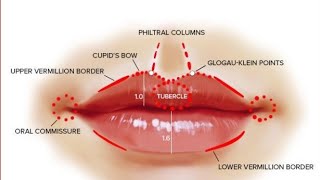 👇 Cosmetic surgery for uneven shaped cupid bow of upper lips due to trauma in Accident [upl. by Loy705]