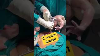 c sectionbreech deliverybaby birthshortsvideo [upl. by Annaeirb866]