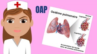 OAP  oedème aiguë du poumon [upl. by Su]