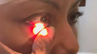 Punctal Occlusion  A simple way to treat dry eye quick amp easy [upl. by Harifaz]