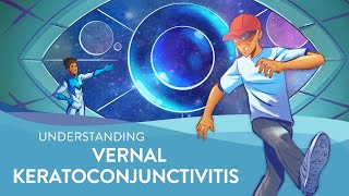 Understanding Vernal Keratoconjunctivitis VKC [upl. by Nnylarat]