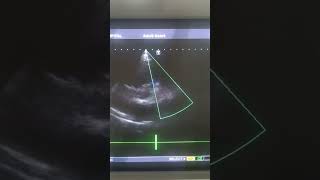 patient with twin pregnancy Sp surgical ASD closure and pulmonary valvotomyfindings3 [upl. by Fancie]