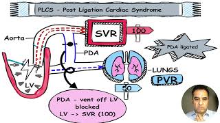 What is Post Ligation Cardiac Syndrome in Neonates [upl. by Reprah]