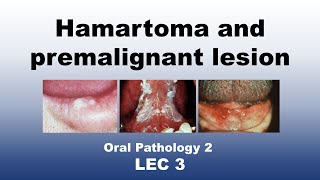 Oral Pathology 2  LEC 3  Classification of Hamartoma and premalignant lesion [upl. by Daphna]