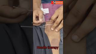 Acupuncture needle therapy acupunctureneedletherapy acupuncture acupressure shorts [upl. by Aleka]