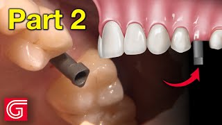 HOW TO Place a Scan Body Implant for a ScrewRetained Crown [upl. by Ettesus935]