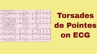 Torsade de Pointes on ECG [upl. by Catt307]