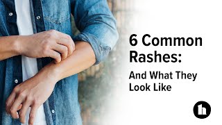 6 Common Rashes And What They Look Like  Healthline [upl. by Atinel]