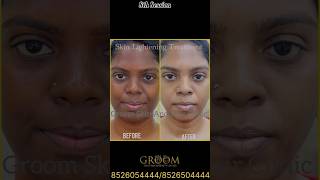 Skin Lightening Treatment Transformation ✨✨✨ [upl. by Jew106]