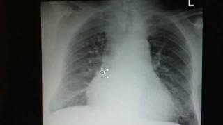 COPD How to Recognize it on a Chest XRay [upl. by Erdied]