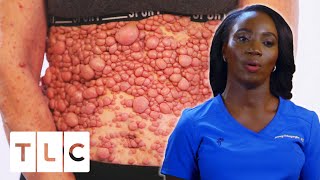 Doctor Treats One Of The Most Extensive Cases Of Neurofibromatosis She’s Ever Seen  Dr Mercy [upl. by Sieber]