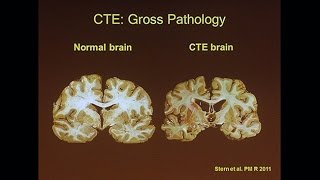 Chronic Traumatic Encephalopathy [upl. by Aurelie]