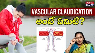 Vascular Claudication Symptoms and Treatment l Dr Niveditha Sai Chandra MedPlusONETV [upl. by Elbring]