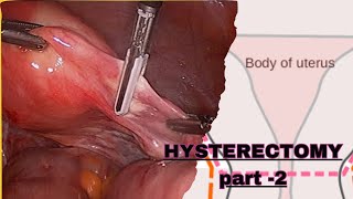 PART  2  NURSING CARE PLAN OF HYSTERECTOMY POST OPERATIVE MANAGEMENT GYNECOLOGICAL NURSING [upl. by Feucht]