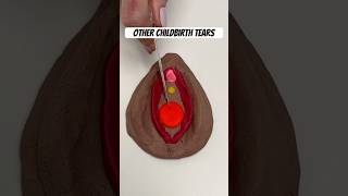 Childbirth tears 101 from a labor  delivery nurse givingbirth birthprep birthtips havingababy [upl. by Joerg]