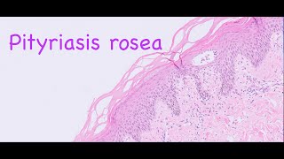 Pityriasis rosea [upl. by Oilenroc876]