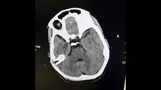 Leukoencephalopathy  Demyelinating disorder [upl. by Mikey]