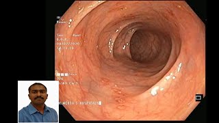 colonoscopyInflammatory bowel diseaseIBDUlcerative colitisEndoscopy biopsyDr Pandiaraja [upl. by Harlene]