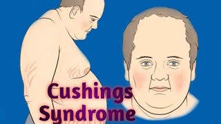 patient with Iatrogenic Cushings Syndrome 2 month follow up [upl. by Leber358]