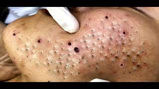 Big Cystic Acne Blackheads Extraction Blackheads amp Milia Whiteheads Removal Pimple Popping 0225 [upl. by Kim]